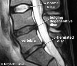 lumbar disc