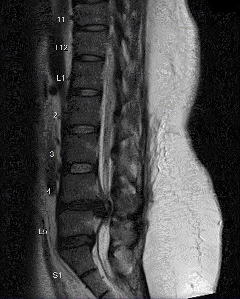 lumbar disc