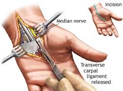 carpal tunnel