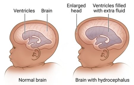 hydrocephalus